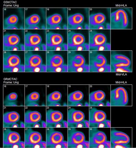 Data Driven Motion Correction Rescues Interpretation Of Rubidium PET