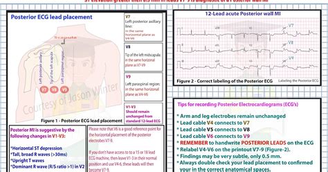 Ecg Educator Blog Posterior Ecg Lead Placement