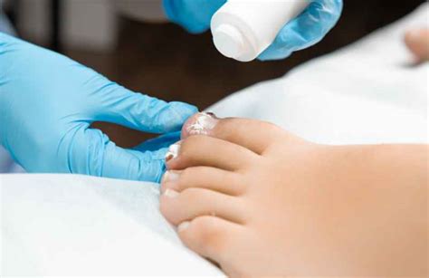 Traitement Des Mycoses Des Ongles Des Pieds Les Solutions Efficaces