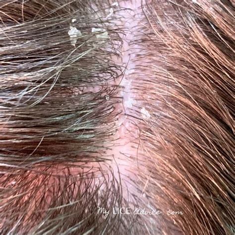 Lice Symptoms With Pictures Signs That You Have Head Lice Artofit