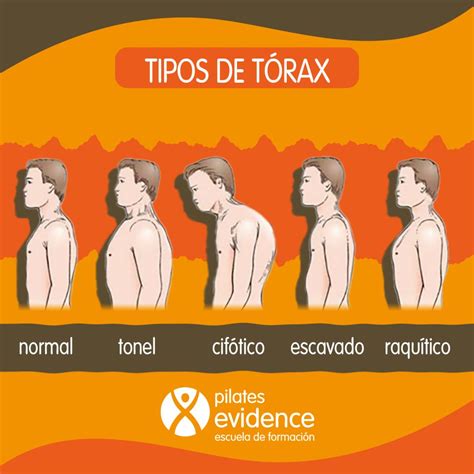 ¿quÉ Tipos De TÓrax O Formas AnÓmalas De TÓrax Existen Y CÓmo