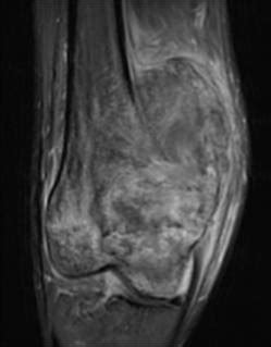 MEDICAL PG QUESTION BANK Telangiectatic Osteosarcoma