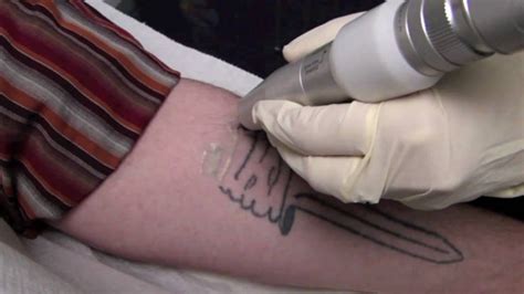 Tout Ce Qu Il Faut Savoir Sur Le D Tatouage Tattoome Le Meilleur Du