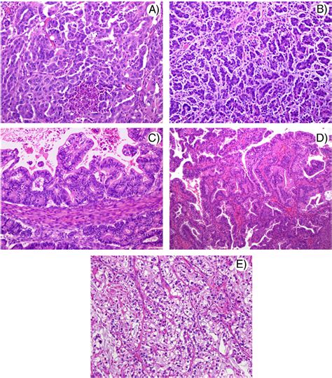 Pathology Of Cancers Of The Female Genital Tract Prat 2015 International Journal Of