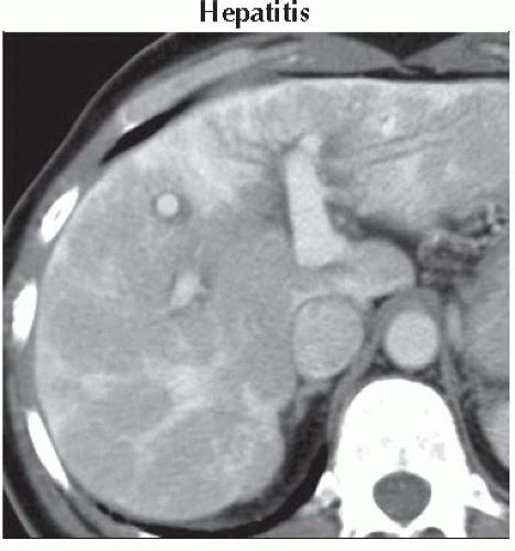 DA9 DB1 Mosaic Or Patchy Hepatogram FFU2 Abdominal Key