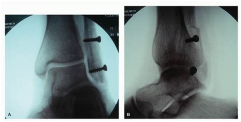 Pes Cavus Surgery | Musculoskeletal Key