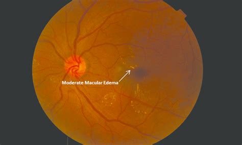 Mild Nonproliferative Diabetic Retinopathy