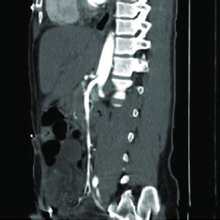 CT Scan Of The Abdomen And Pelvis With Intravenous Contrast