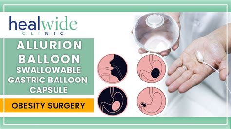 Allurion Ballon Elipse Ballon Gastric Ballon Weight Loss