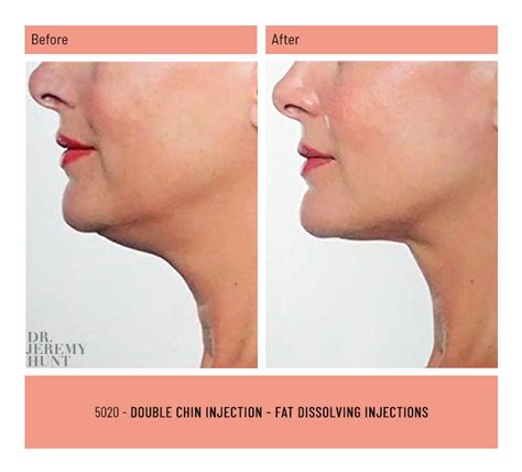 5020 Double Chin Injection Fat Dissolving Injections Dr Jeremy Hunt