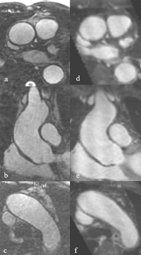 Radial Self Navigated Native Magnetic Resonance Angiography In Comparison To Navigator Gated