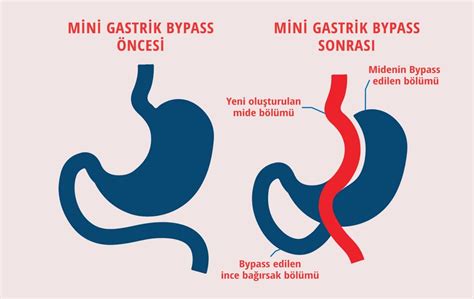 Mini Gastrik Bypass Ameliyatı Nedir Doç Dr İsmail Yaman Obezite