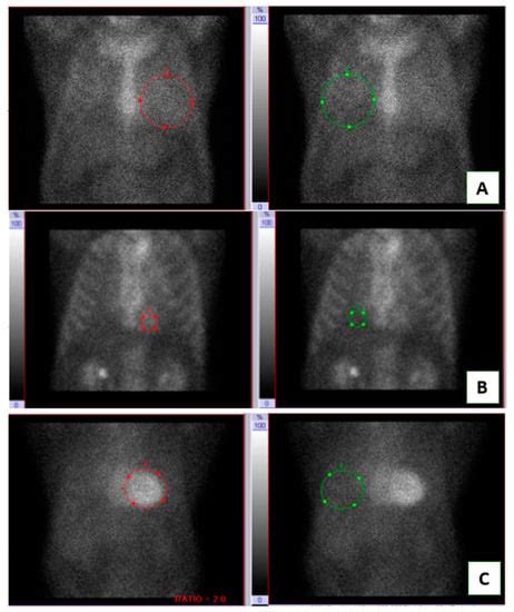 Medicina Free Full Text Towards A Diagnosis Of Cardiac Amyloidosis