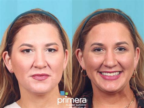 Endoscopic Forehead Lift Before And After Photo Gallery Orlando