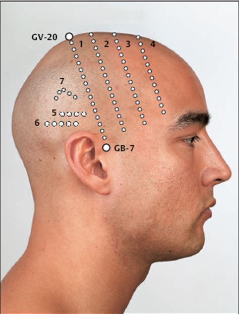 Chinese Scalp Acupuncture | Musculoskeletal Key