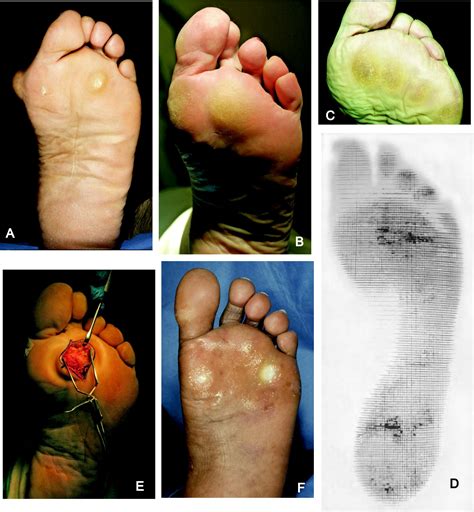 2nd Metatarsal Overload Syndrome Treatment - Captions Trend Today