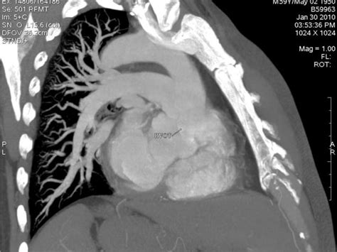 Ct Pulmonary Angiogram Ppt