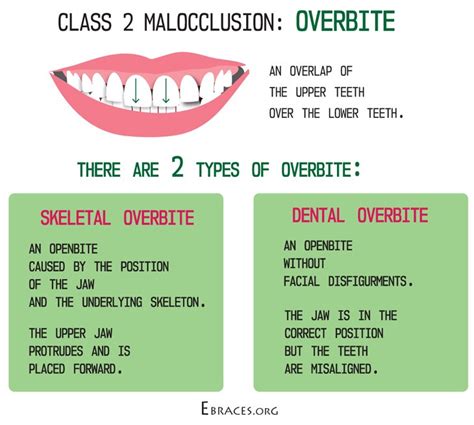 What Is Malocclusion Of The Teeth And How To Treat It