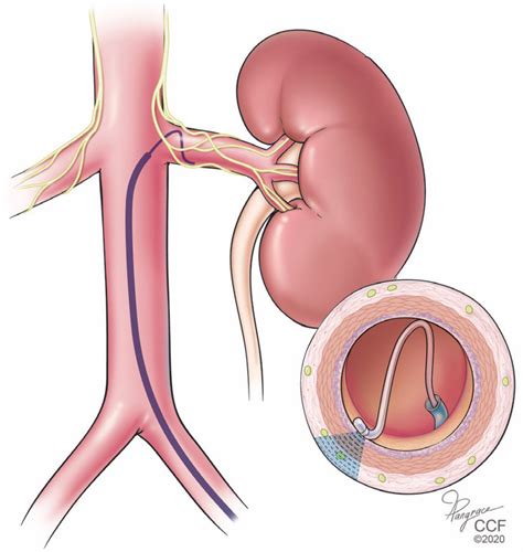 Procedures And Devices To Treat Resistant Hypertension In Chronic