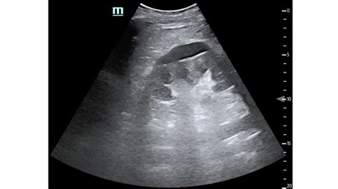 Nephrostomy Tube Ultrasound