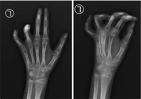 Preoperative radiograph showing flexion contracture at PIP joint at the ...