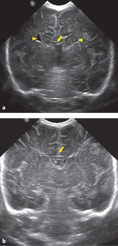 Agenesis Of Corpus Callosum Ultrasound