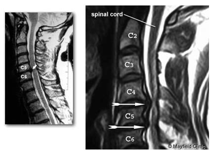 Hernia De Disc Cervicala