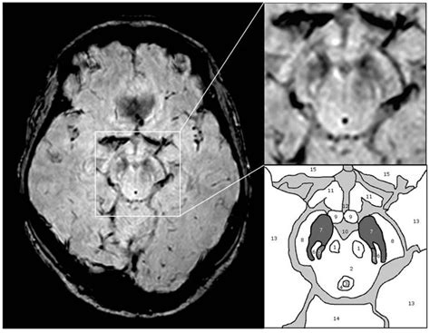 substantia nigra anatomy parkinsons plos – Neuroscience News