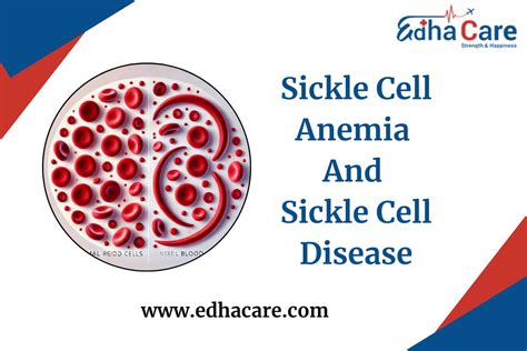Sickle Cell Anemia And Sickle Cell Disease The Detail Guide