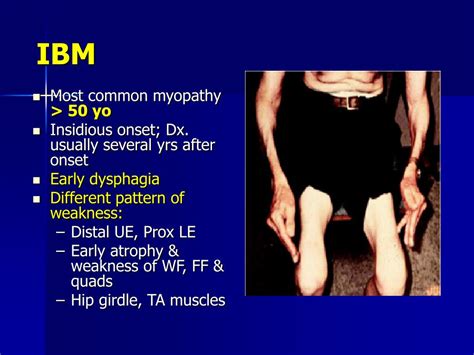 Ppt Recognition Investigation And Treatment Of Myopathies Powerpoint