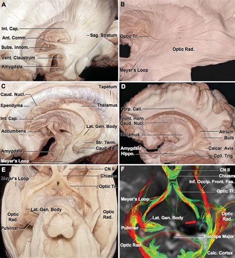 Optic Radiation A Removal Of The Medial Fibers Of The Uncinate Download Scientific Diagram