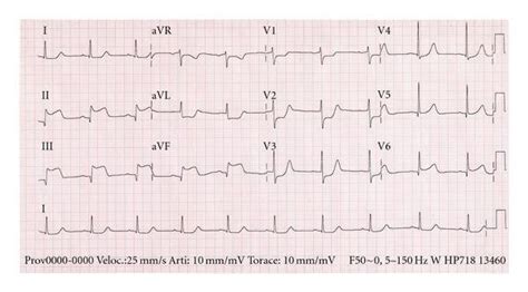 St Elevation Lead 2