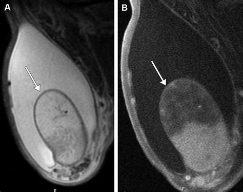 Mr Imaging Of The Testicular And Extratesticular Tumors Magnetic