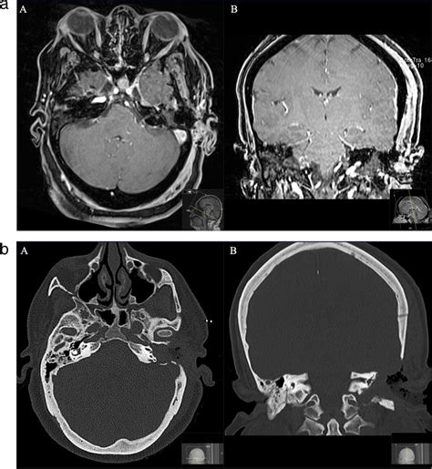 A A Postoperative Axial And B Coronal T1 Weighted Gadolinium Enhanced