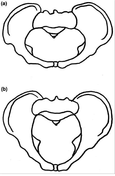 Schematic of (a) platypelloid and (b) anthropoid pelvis types ...