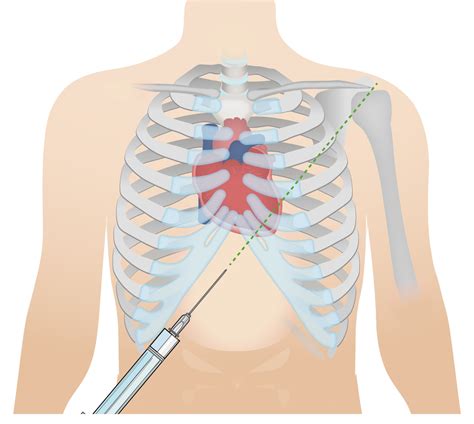 Pericardial Window Procedure Steps