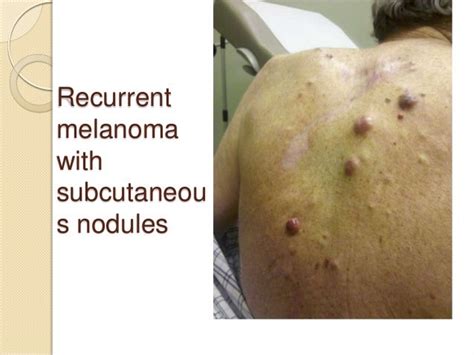 Melanoma Symptoms Stage 2 - Doctor Heck