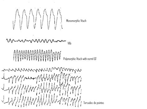 Ventricular Tachycardiafibrillation Wide Complex Tachycardias