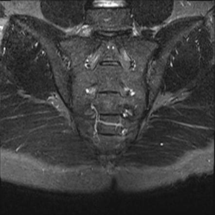 Sacroiliac Joint Mri