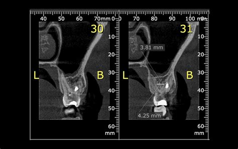 Implante Curto Imediato Unit Rio Fgm Dental Group