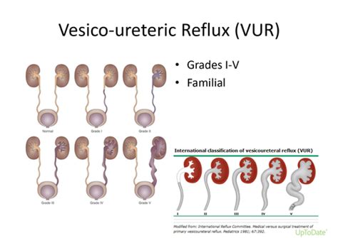 Congenital Anomalies Of Kidney And Urinary Tract Pyelonephritis