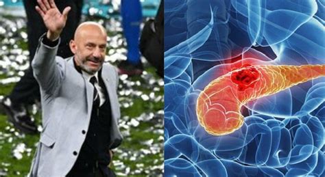 Gianluca Vialli Il Tumore Al Pancreas E Il Dottore Che L Ha Operato