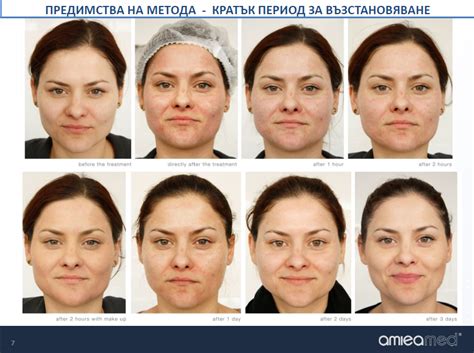 Медицински микронидлинг - Д-р Ася Данчева, Дерматолог в София
