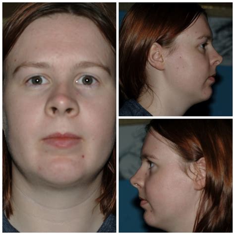 Recovery - Jaw Breaking Surgery