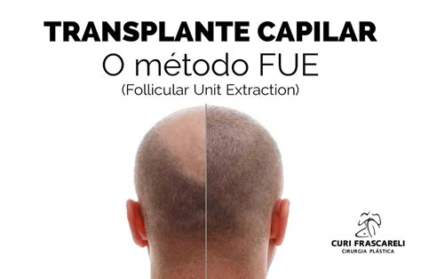 Transplante Capilar O método FUE Follicular Unit Extraction Guia