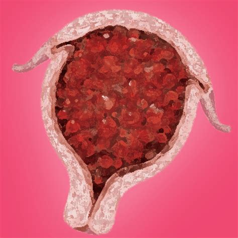 Gestational Trophoblastic Disease Current Evaluation And Management