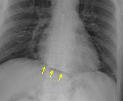 Continuous Diaphragm Sign Radiology Cases