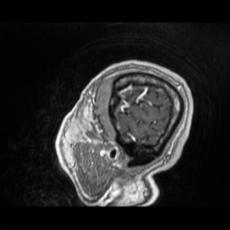 Filecerebellar Metastasis Of Pulmonary Adenocarcinoma Cavernous Venous Malformation And