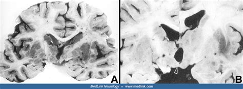 Korsakoff syndrome | MedLink Neurology