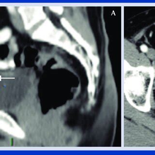 Tomografía de abdomen y pelvis corte sagital A y axial B que